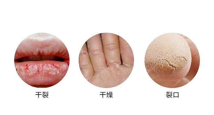 手足皲裂涂进口药膏效果好,手足干燥皲裂用什么防裂膏