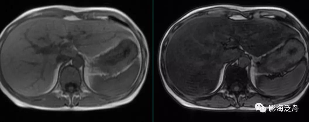 肝脏弥漫性病变严重吗,肝脏弥漫性的病变的症状