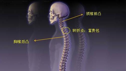 脖子上长富贵包其实是患了颈椎病,脖子后面的富贵包什么方法能去掉