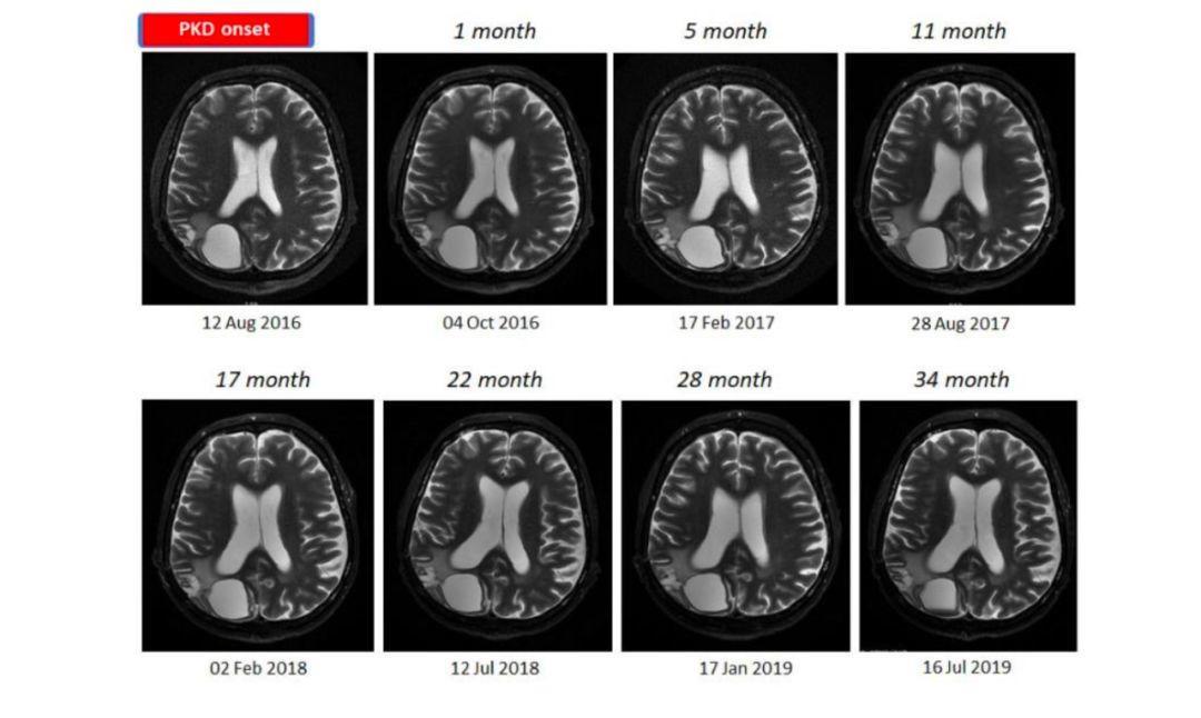 70%食物全是肉，3年控制癌症，这个老外案例，值得每个人看一看
