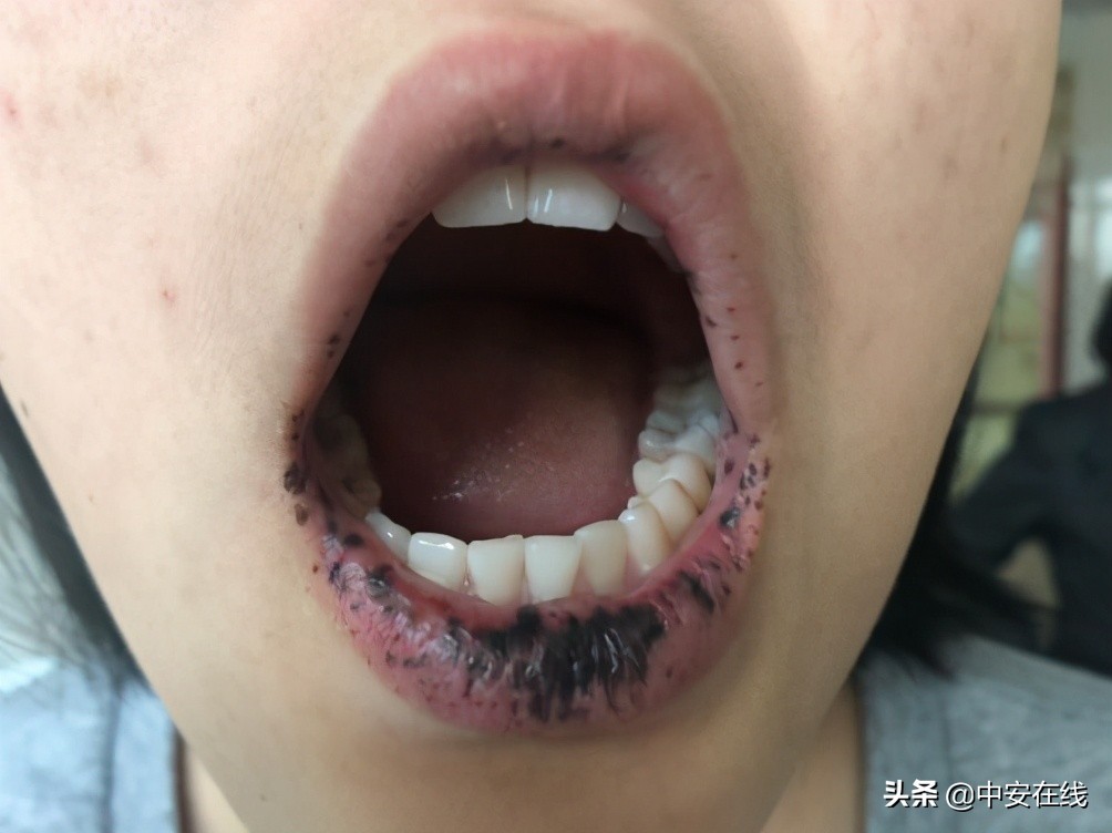 18岁时候嘴唇长黑斑,脸上有黑斑的小女孩做手术