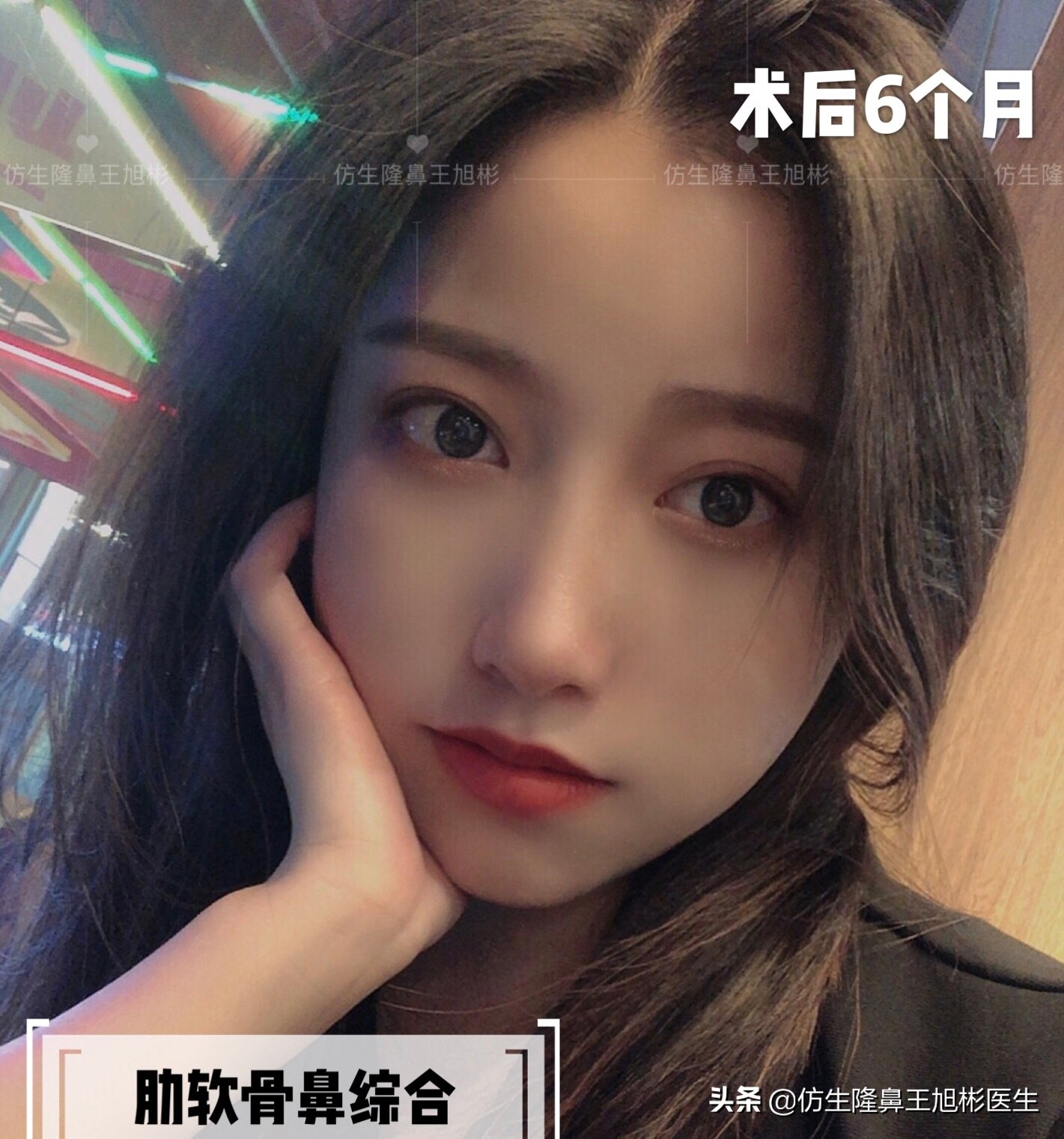 手术鼻头增厚能用什么方法弄,大鼻头高鼻梁缩小手术案例