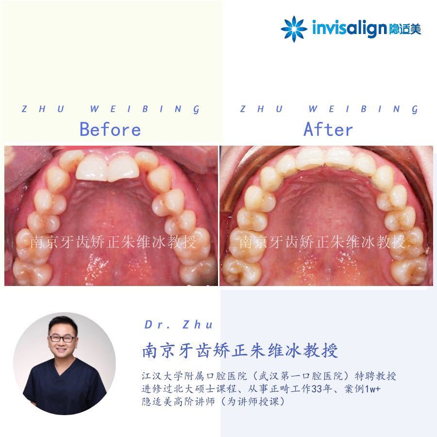 南京口腔医院矫正一颗牙齿多少钱,大医院为啥不建议做牙齿矫正