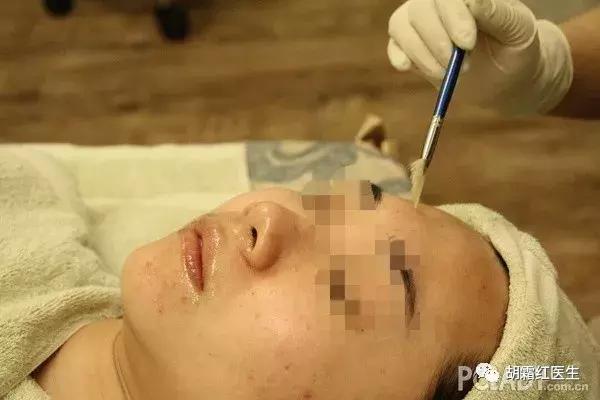 果酸换肤效果特别明显,果酸换肤亲身经历效果好不好