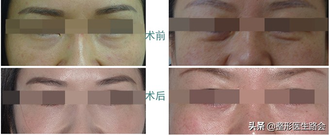 玻尿酸填充泪沟20多天了还有淤青,填充眼袋泪沟的淤青怎么才会消除