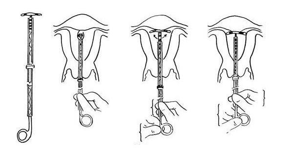 取环备孕需要准备什么,取环备孕注意什么