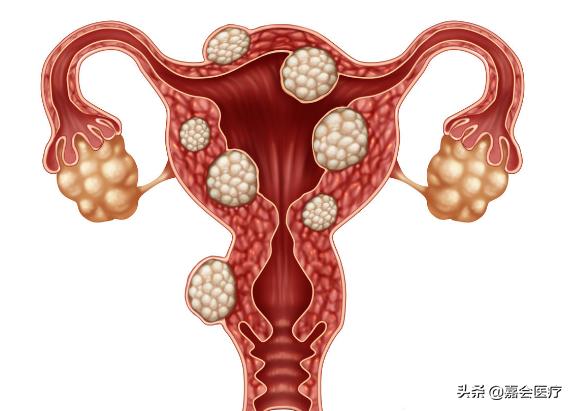 月经淋漓不尽该注意什么,子宫肌瘤5cm月经淋漓不尽怎么办