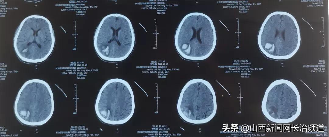 “与狼共舞”不再是梦——长治医学院附属和济医院肾内科救治一例肾衰竭合并脑出血患者