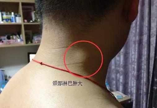 癌症怎么转移,癌症是怎么转移的图