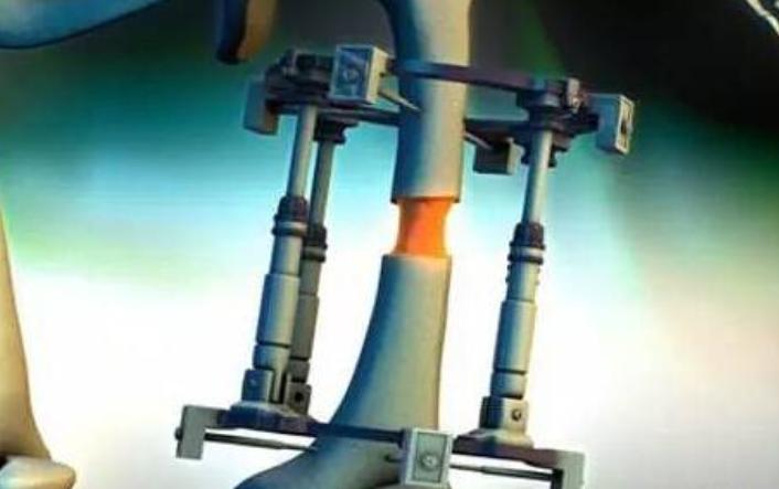 断骨长高李亚诺现状,中国断骨增高第一人李亚诺