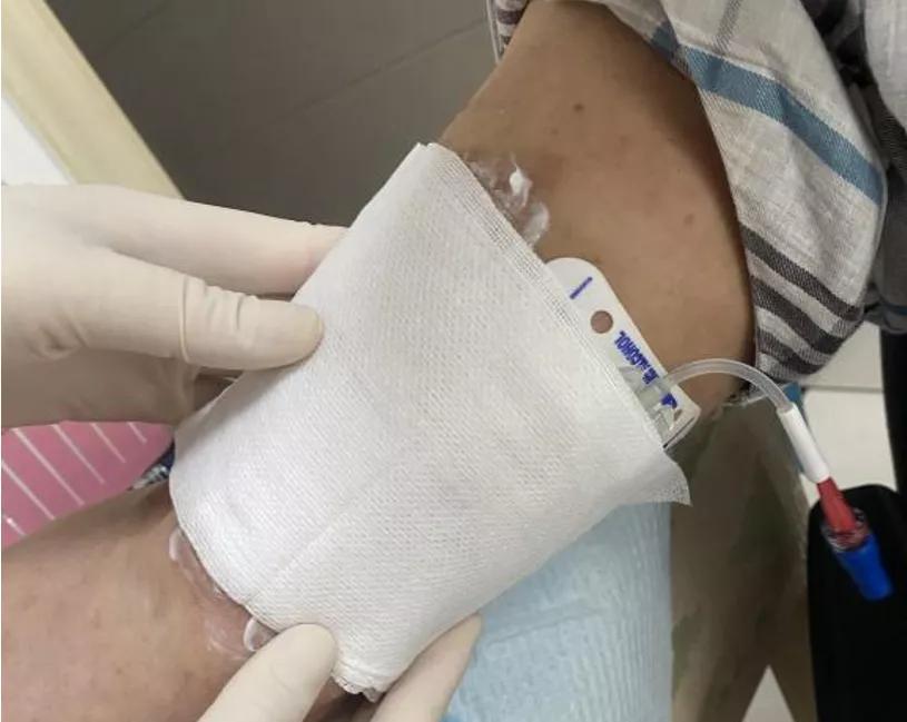 picc置管敷贴皮肤痒如何处理,picc置管防过敏贴膜进口