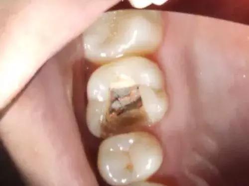 补牙4年后钻心的痛怎么回事,补牙一两年后出现疼痛什么原因