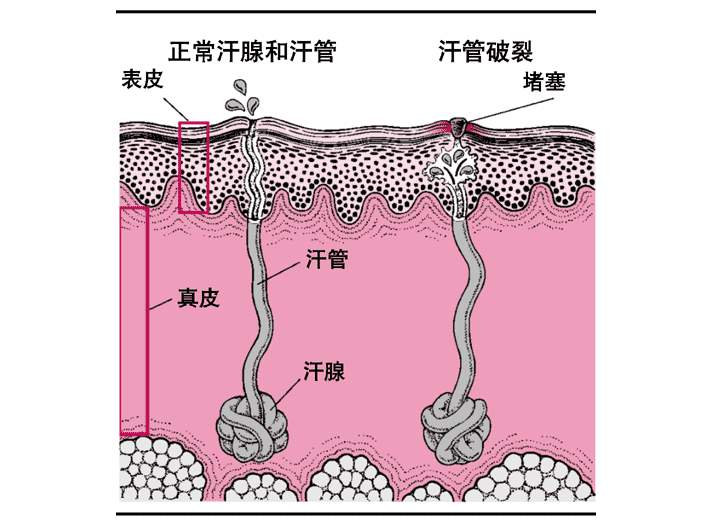 长痱子怎么办婴幼儿,长痱子怎么办