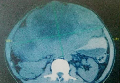 巨型肝癌从查出到死真实情况,肝癌10厘米治愈案例