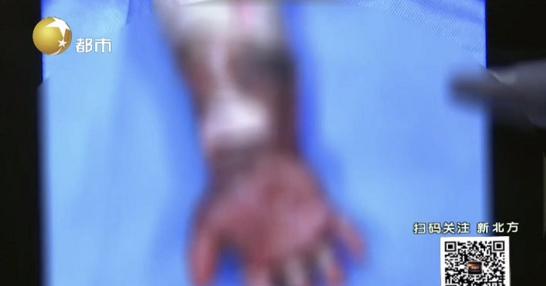 一岁宝宝被开水烫伤后皮肤发红,宝宝被开水烫伤破皮放了酱油