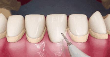 牙齿牙根没长全该怎样护理,《牙齿》护理攻略