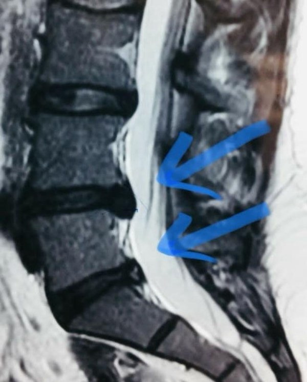 总是腰痛需不需要治疗,总是莫名腰疼