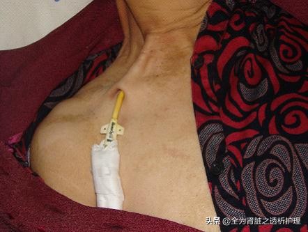 血透室中心静脉导管护理ppt,血透用瘘后能洗澡吗