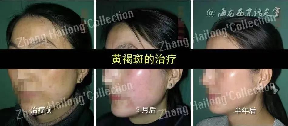 褐斑怎么办,褐斑怎么治才能除根