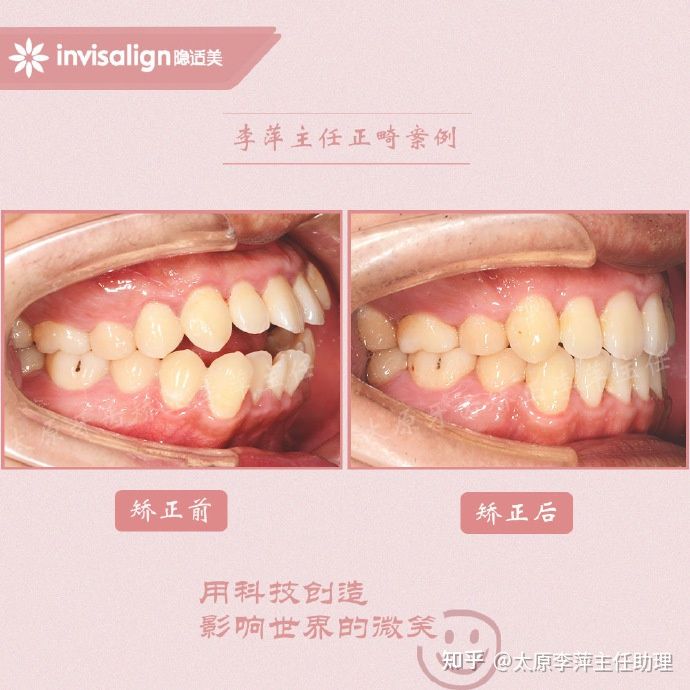 太原矫正牙齿需要做正颌吗,太原牙齿二次矫正