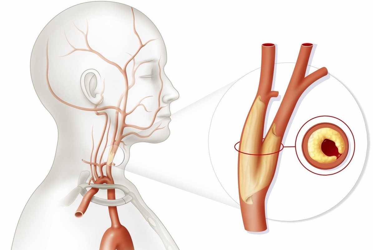 颈动脉斑块与阿司匹林,颈动脉斑块吃他汀还是阿司匹林好