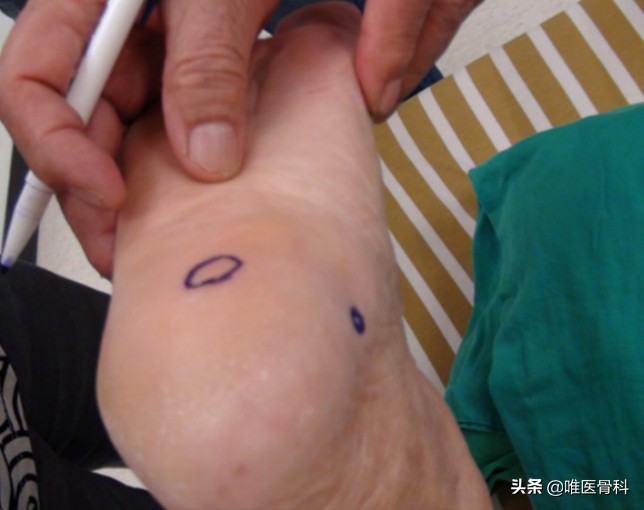 足底受力疼早上起床明显发作反复,足底痛一招教你解决