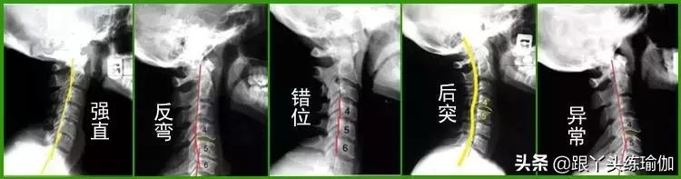 初学瑜伽颈椎基本动作视频,颈椎瑜伽初学入门视频教程