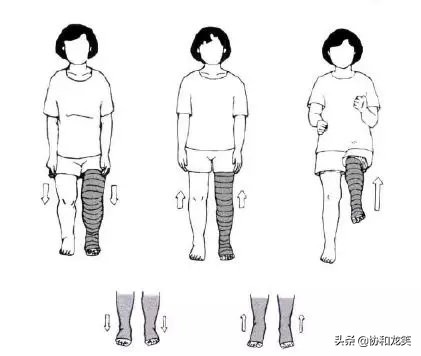 下肢淋巴水肿的治疗手段是哪些呢,淋巴水肿的功能锻炼