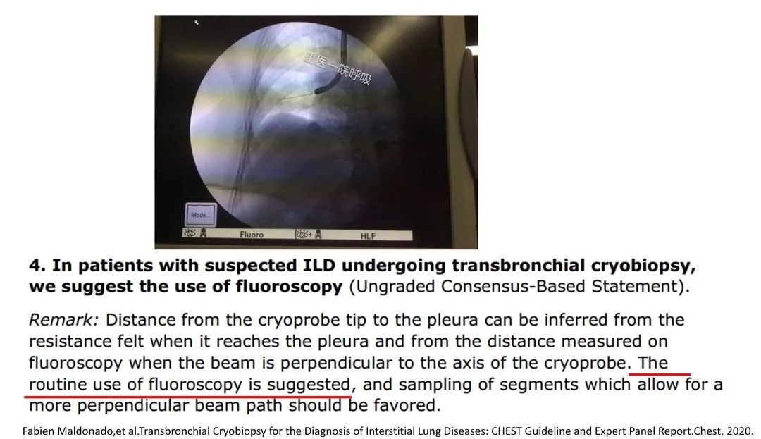 经皮肺穿刺活检术过程,经支气管冷冻肺活检