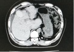 肝硬化及炎症手术的难度很大,肝硬化细胞治疗最新临床课题