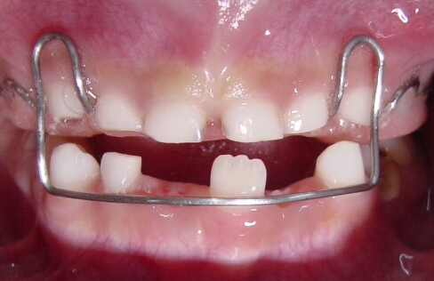 9岁孩子口内出现双排牙，怎么办｜莫急，口腔医生为你支一招