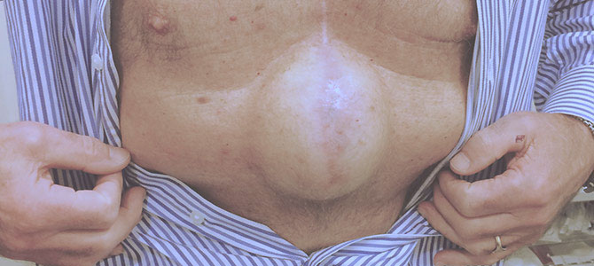 疝气如果有肠坏死做什么手术,腹股沟疝引发肠子坏死治疗费用