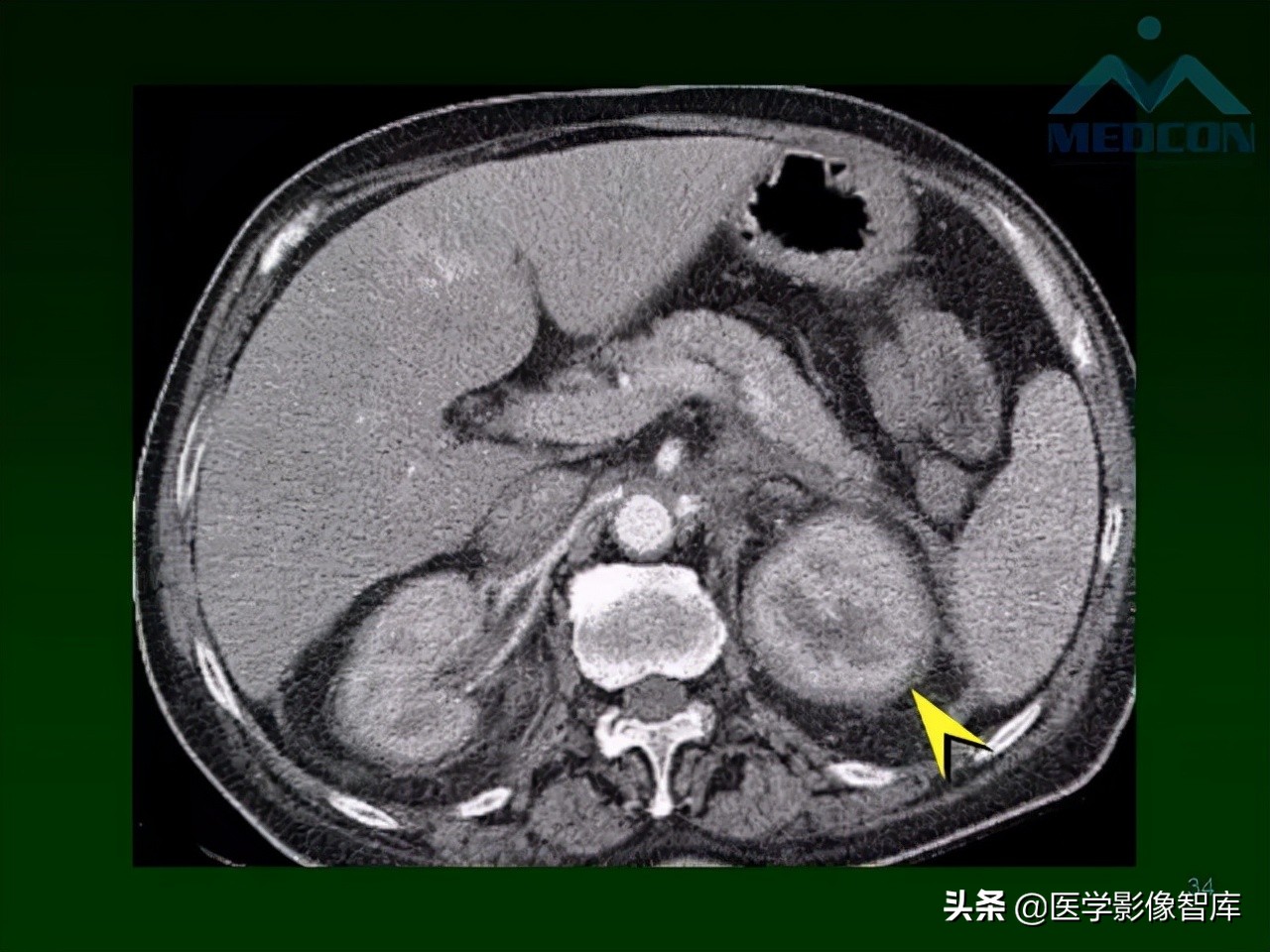 肺弥漫性网状影,两肺小叶间隔增厚可见网状模糊影