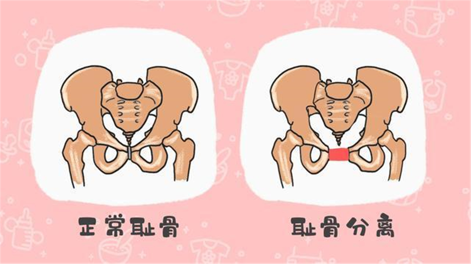 孕期“耻骨”疼到坐也不是站也不是？这五类孕妇，要尤其注意