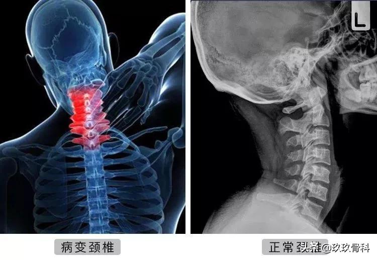 颈椎死穴,颈椎上的死穴在哪里