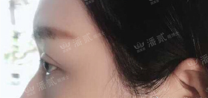 10个工作室做，9个毁，祛眼袋连卧蚕也没了，直接送我到10年后