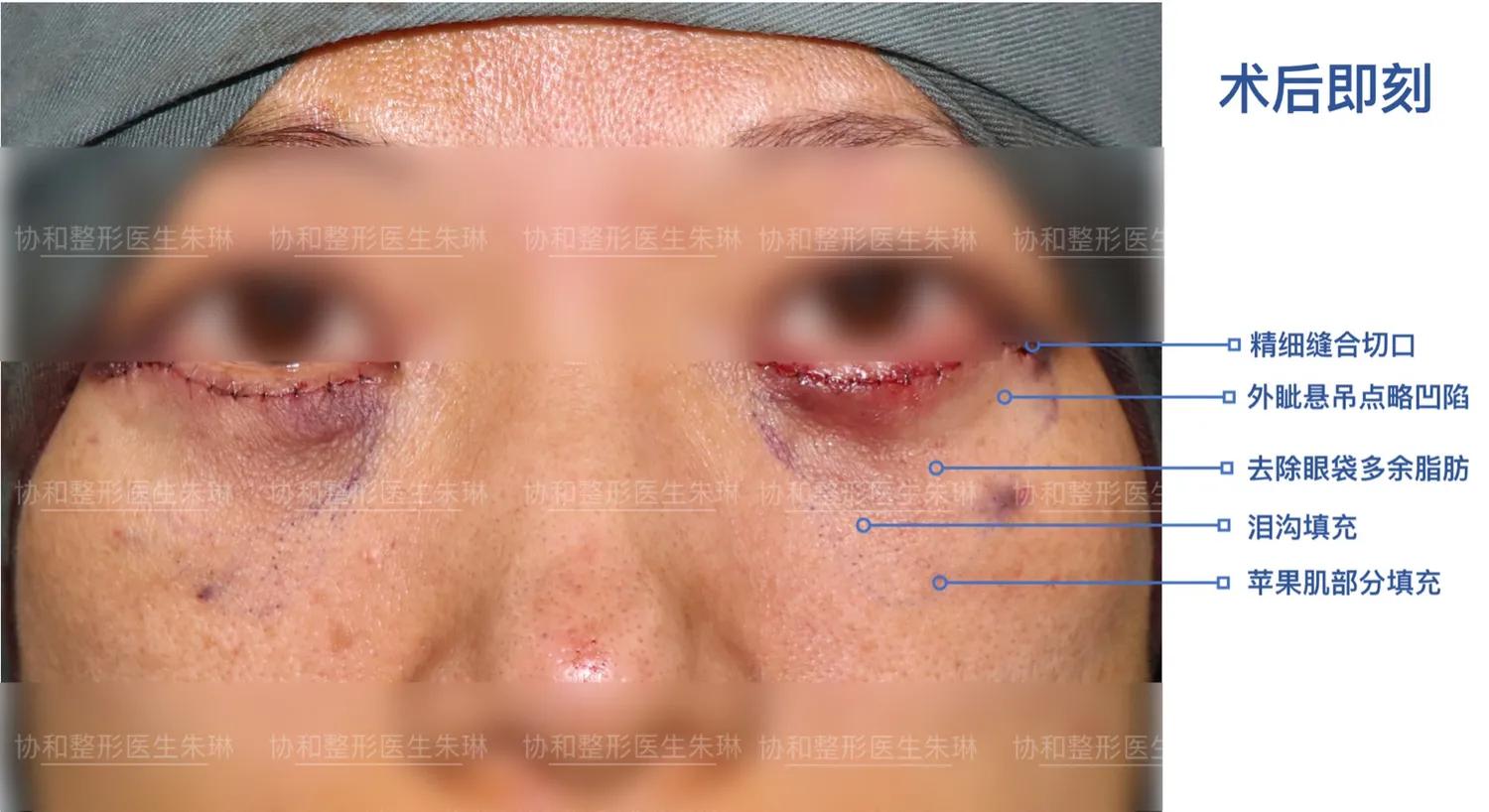 外切眼袋消肿食谱,外切眼袋20天效果图