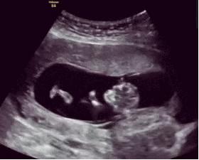 孕期感觉宝宝胎动一直是在左边,怎么判断胎儿左侧胎动多少