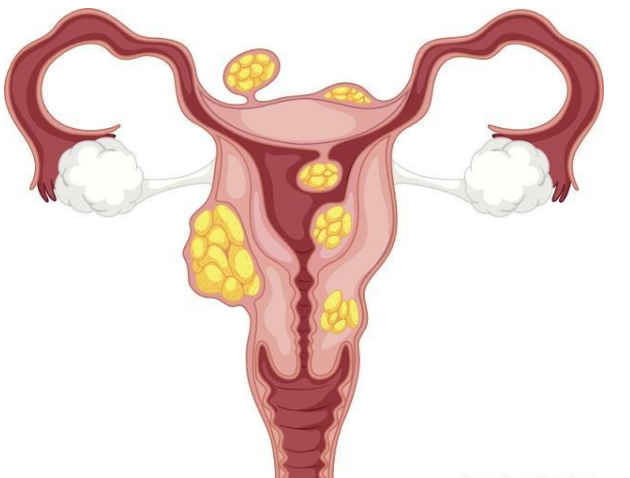子宫肌瘤有什么症状可以自愈吗,子宫肌瘤该不该切子宫