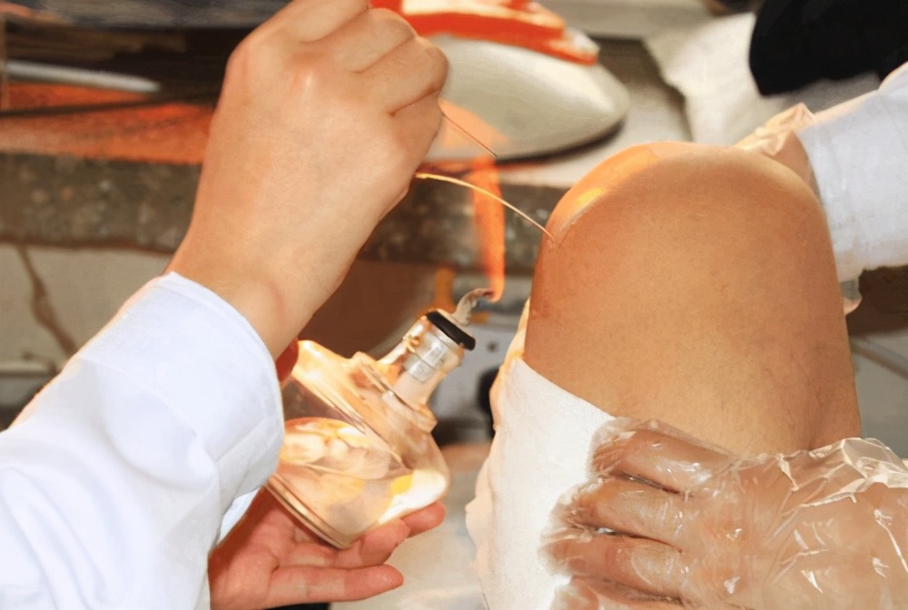 田庆华老师火针疗法治静脉曲张,火针疗法静脉曲张教学视频