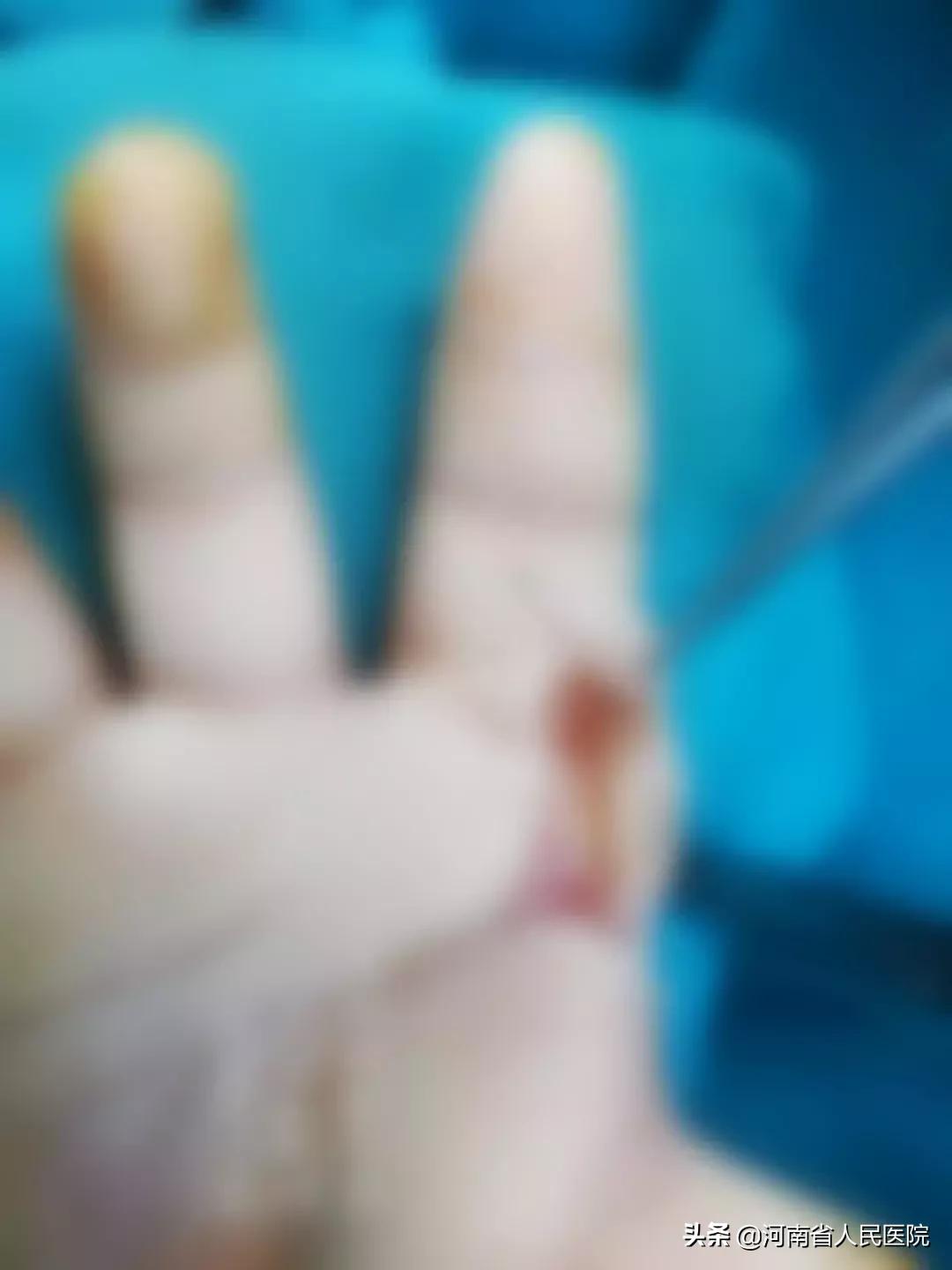 儿童竹签扎进嘴,竹签扎到小孩图片