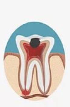 蛀牙不痛不杀神经能补牙吗,蛀牙不痛需要拔掉吗