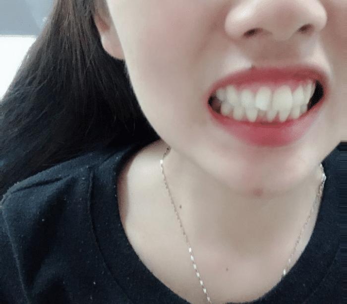 牙套隐形日记,牙套日记正颌