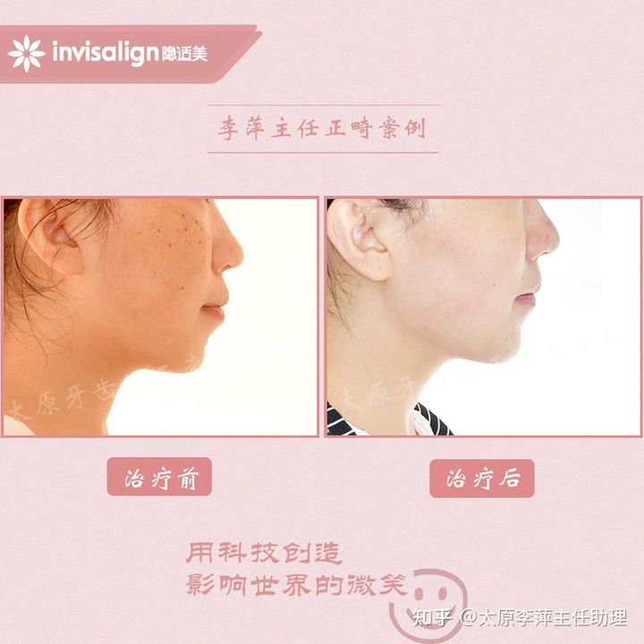 太原整牙齿矫正要多少钱,坏牙齿只剩牙根有必要拔牙吗