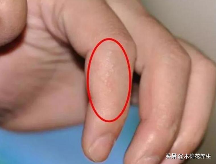 手上长小水泡很痒可以把泡刺破吗,手上起的小水泡很痒怎么快速消除