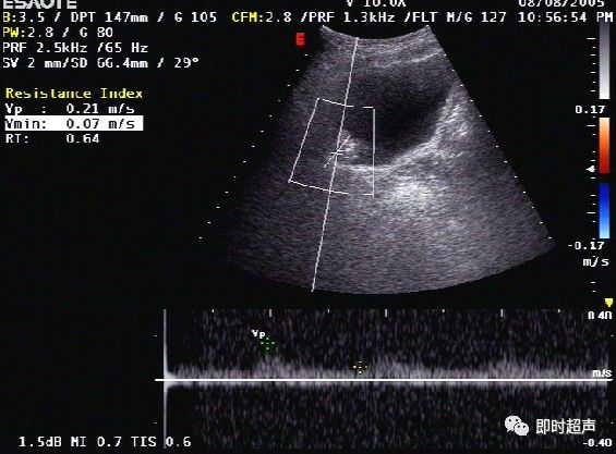 膀胱超声图解大全,膀胱超声解剖及常见病变超声表现
