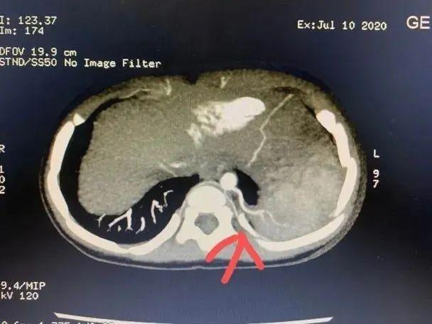 宝宝咳嗽伴有反复发烧福州,1岁8个月宝宝反复发烧肺部有痰