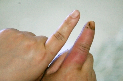 鱼刺扎手了找不到鱼刺怎么办,鱼刺扎手肿了的毒素叫什么