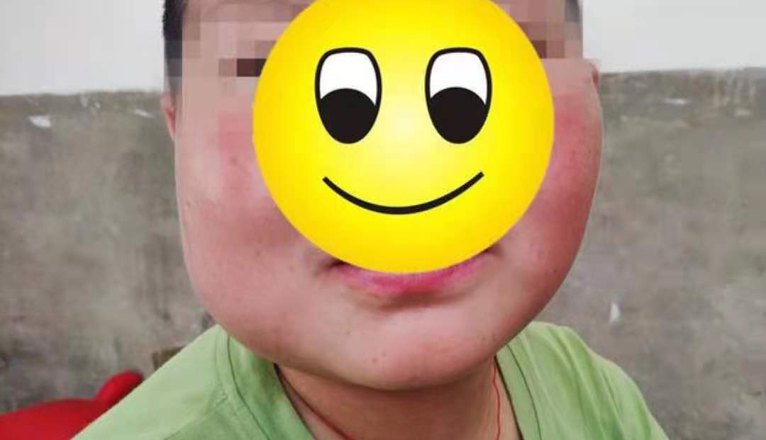 小孩嘴巴有恶性肿瘤,男童长出5斤肿瘤完整版