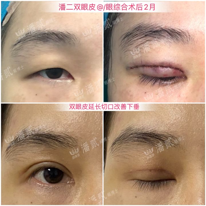 割了开扇双眼皮眼尾上扬太宽,眼尾上扬的眼睛适合什么双眼皮